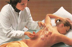 In Cina l'obesità si cura con il cupping In Cina l'obesità si cura con il cupping