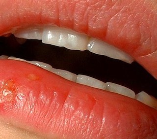 Prevenire l’herpes alle labbra con rimedi naturali