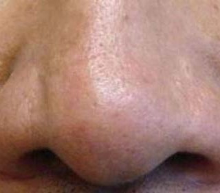 Cellule staminali: a un uomo ricostruito il naso su un braccio