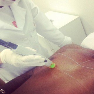 Epilazione laser: ecco come funziona e che rischi comporta