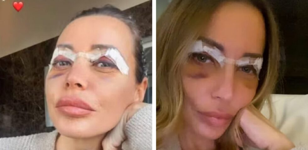 La risposta di Karina Cascella alle critiche degli haters per la blefaroplastica La risposta di Karina Cascella alle critiche degli haters per la blefaroplastica