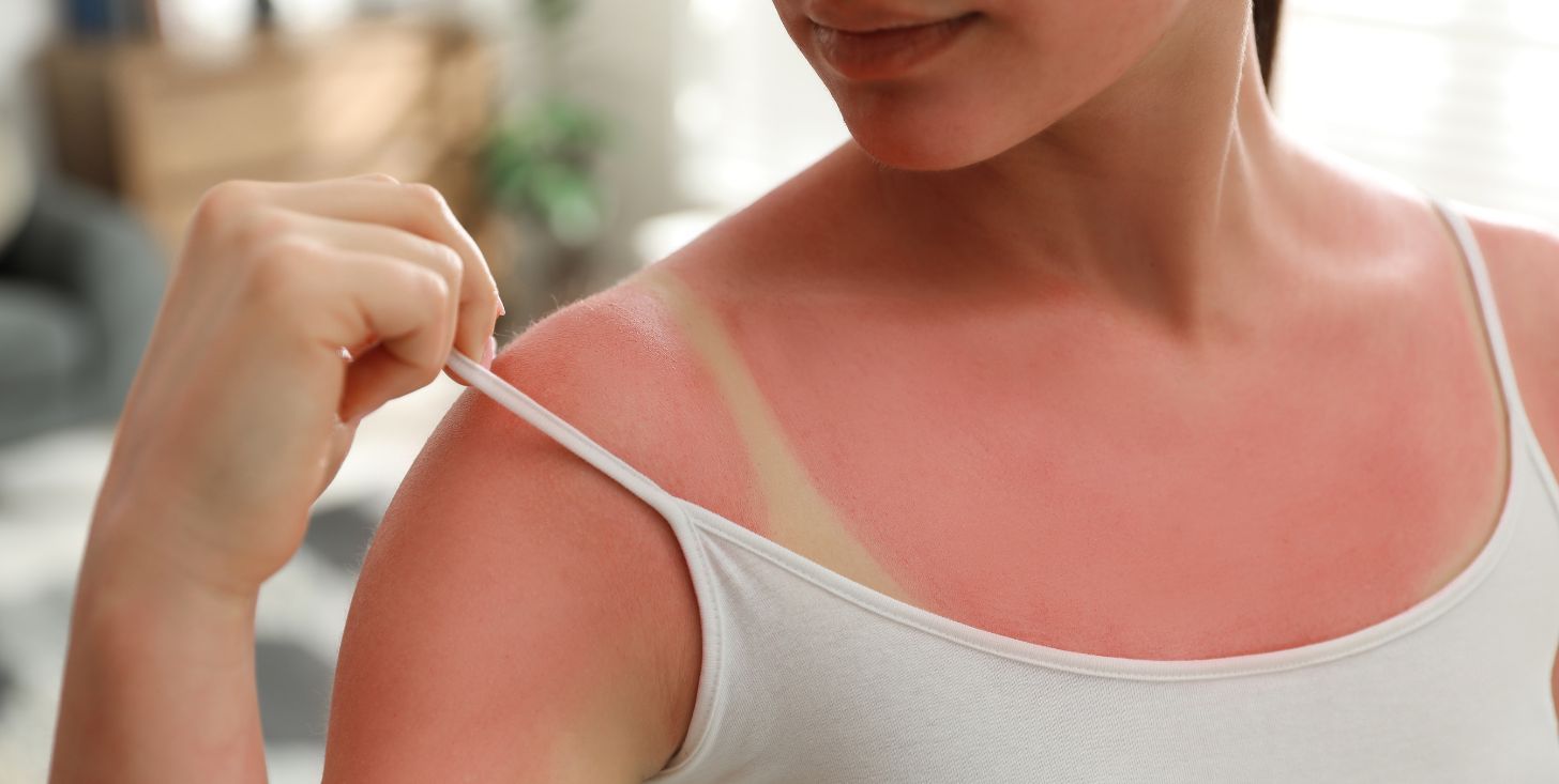 eritema solare cosa fare se la pelle 232 stata sovraesposta ai raggi uv